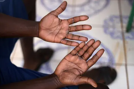 A miner, who spoke on condition of anonymity out of fear of reprisals, shows bruises on his hands that he got while climbing out of the mine, during an interview with The Associated Press, in Stilfontein, South Africa, Wednesday, Jan. 15, 2025. (AP Photo/Themba Hadebe)