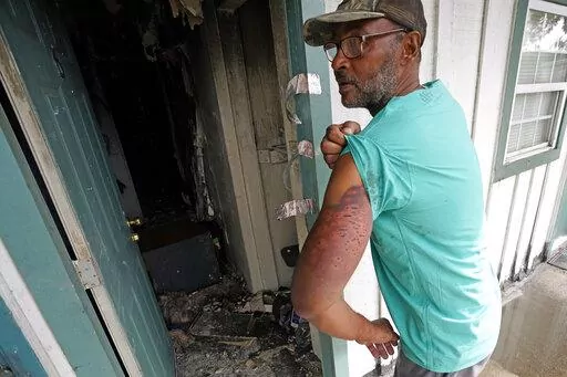 Shooting survivor Michael James shows his shotgun wounds while standing outside his fire-damaged apartment, Monday, Aug. 29, 2022, in Houston. Houston police say a man evicted from an apartment set fire to the building early Sunday to lure out other tenants, then fatally shot three and wounded two others, including James. (AP Photo/David J. Phillip)
